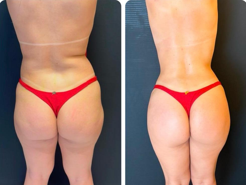 Lipoaspiração de costas e flancos com desenho corporal posterior
